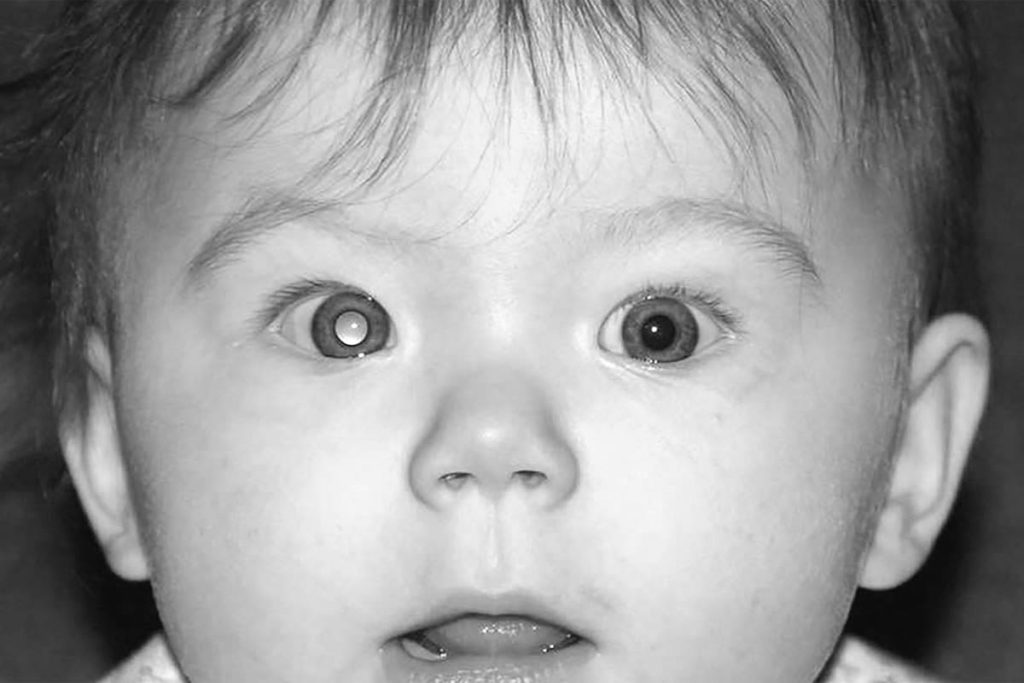 Retinoblastoma What You Need to Know